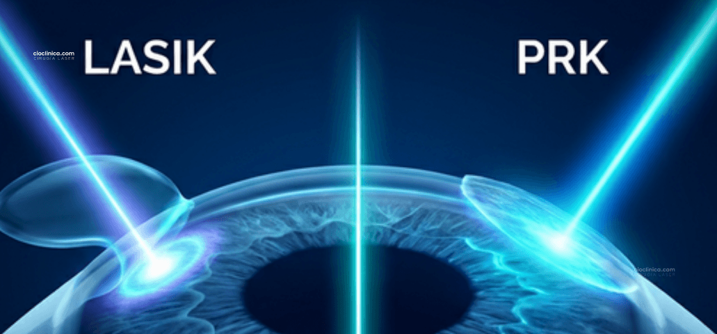 cirugía LASIK vs PRK en CDMX
